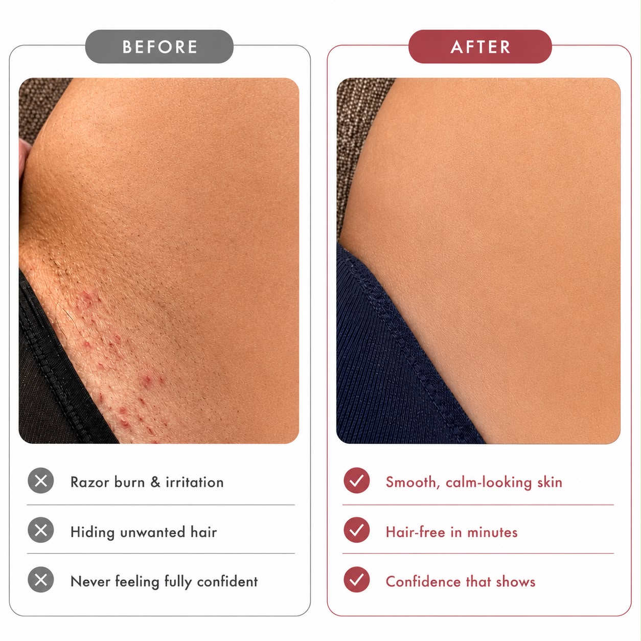 Women's bikini line trimmer before and after results, helping reduce razor burn, ingrown hairs, and post-shave irritation.